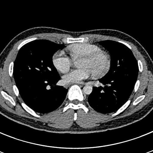 Apical lung mass mimic - neurogenic tumor (Radiopaedia 59918-67521 A 47).jpg