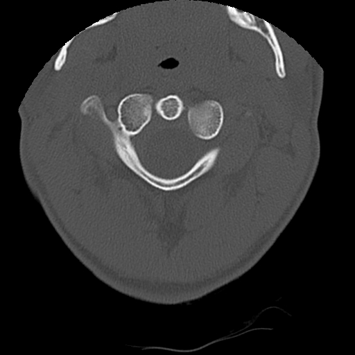 Apical pneumothorax on cervical spine CT (Radiopaedia 45343-49368 Axial bone window 16).jpg