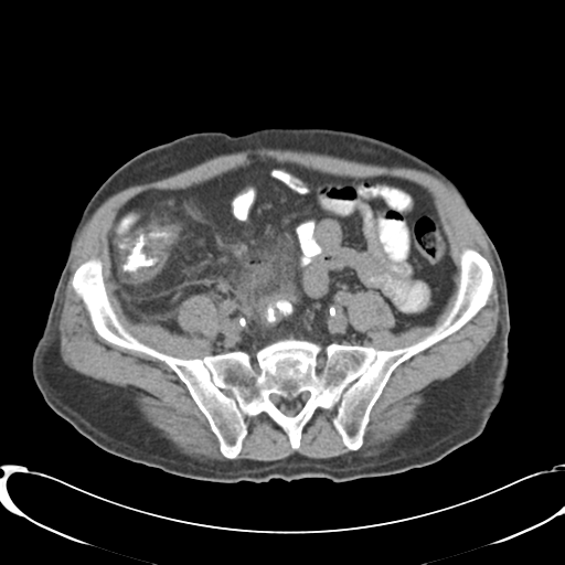 File:Appendiceal abscesses (Radiopaedia 50999-56542 Axial non-contrast 58).png