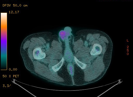File:Appendiceal adenocarcinoma complicated by retroperitoneal abscess (Radiopaedia 58007-65041 Axial PET-CT 203).jpg