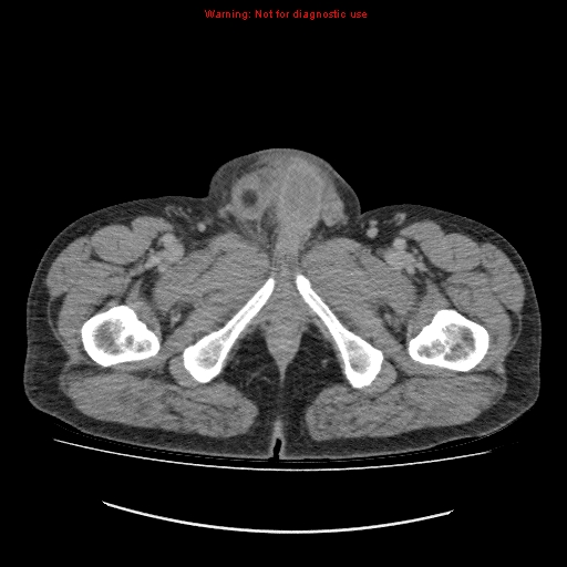 File:Appendicitis mass in inguinal hernia (Radiopaedia 26858-27029 A 38).jpg