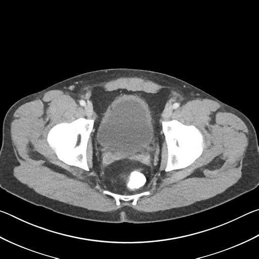 Appendicitis with cecal bar sign (Radiopaedia 31878-32830 B 75).jpg