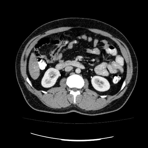 File:Appendicitis with diverticulosis (Radiopaedia 47693-52383 Axial C+ 61).jpg