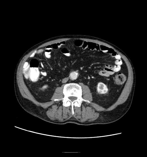Appendicitis with localized perforation and abscess formation (Radiopaedia 49035-54130 A 49).jpg