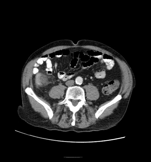 Appendicitis with localized perforation and abscess formation (Radiopaedia 49035-54130 A 57).jpg