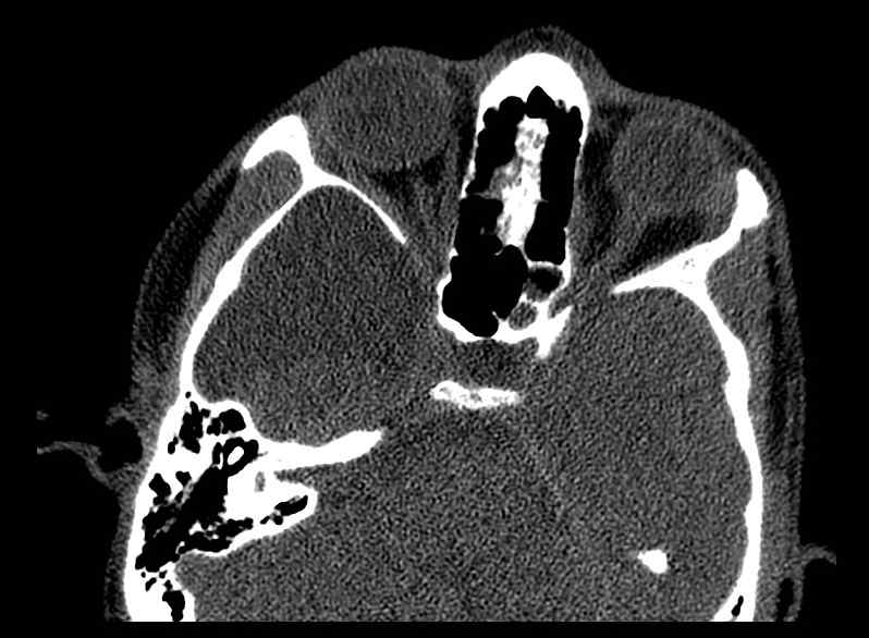 Arachnoid cyst- extremely large (Radiopaedia 68741-78450 Axial bone window 24).jpg
