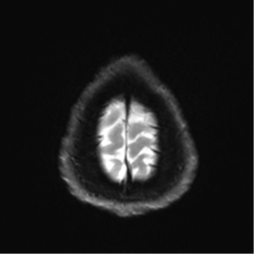 Arachnoid cyst - cerebellopontine angle (Radiopaedia 59689-67083 Axial DWI 34).png