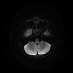 Arachnoid cyst - middle cranial fossa (Radiopaedia 86780-102938 Axial DWI 23).jpg