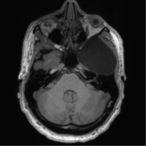 File:Arachnoid cyst with subdural hematoma (Radiopaedia 85892-101743 Axial T1 25).png