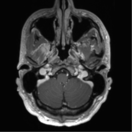 Arachnoid cyst with subdural hematoma (Radiopaedia 85892-101743 Axial T1 C+ 16).png