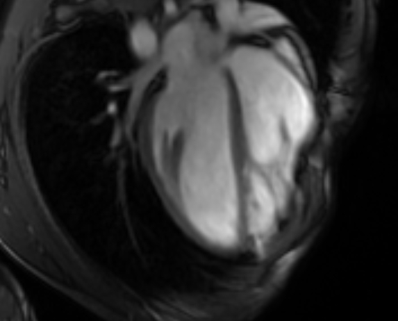 Arrhythmogenic right ventricular cardiomyopathy (Radiopaedia 69564-79464 4ch cine 59).jpg