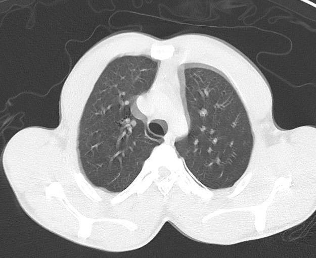 File:Arrow injury to the chest (Radiopaedia 75223-86321 Axial lung window 14).jpg