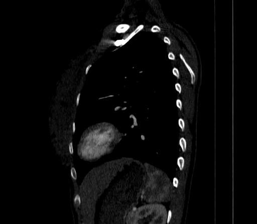 Arteria lusoria (Radiopaedia 88528-105192 C 68).jpg