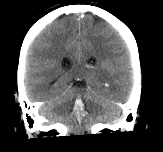 File:Arteriovenous malformation (cerebral) (Radiopaedia 40070-42579 Coronal non-contrast 25).png
