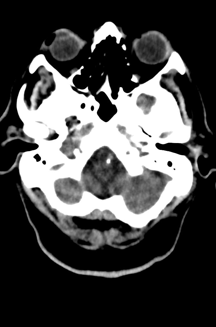 Artery of Percheron infarction (Radiopaedia 80613-94202 Axial non-contrast 37).jpg