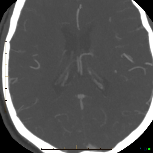 File:Artifactual basilar artery stenosis due to metallic stent (Radiopaedia 31206-31923 A 27).jpg