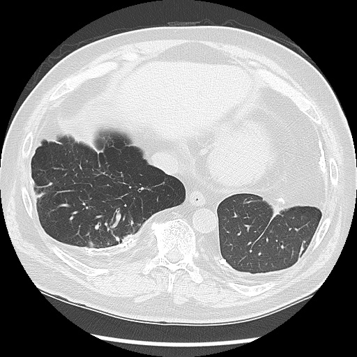 Asbestos-related pleural disease (Radiopaedia 74366-85250 Axial lung window 90).jpg