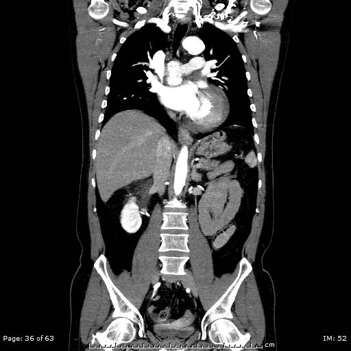 Ascending aortic aneurysm (Radiopaedia 50086-55404 B 36).jpg