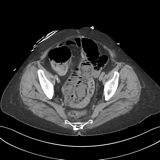 File:Ascending cholangitis (Radiopaedia 39068-41253 Axial non-contrast 57).png