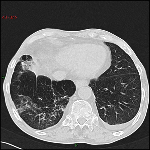 File:Aspergilloma (Radiopaedia 14842-14787 Axial lung window 37).jpg