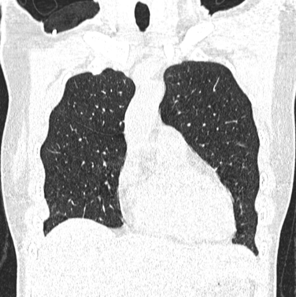 File:Aspergilloma (Radiopaedia 26223-26347 Coronal lung window 14).jpg