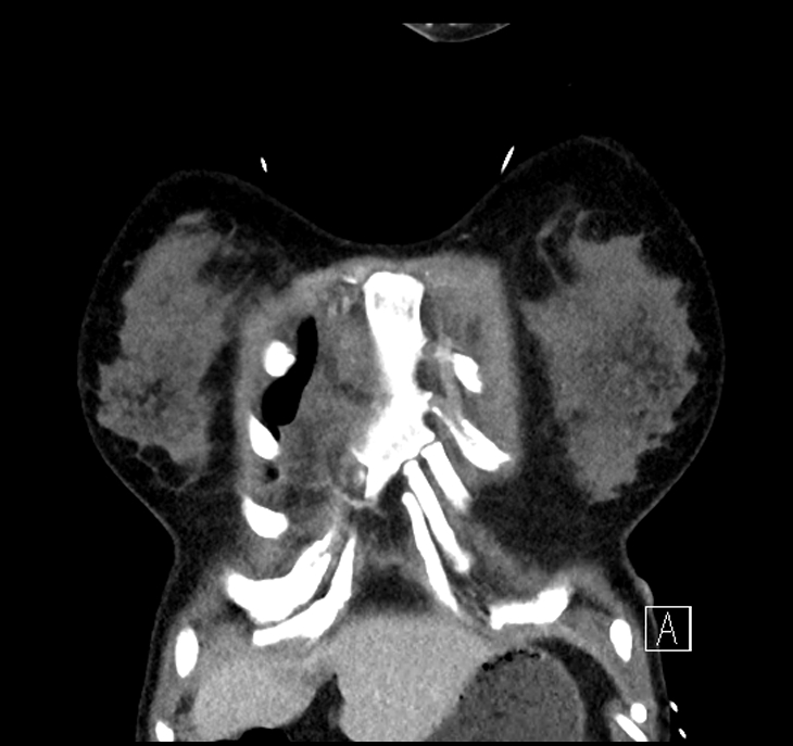 Aspiration pneumonia complicated by empyema (Radiopaedia 73024-83767 A 2).jpg