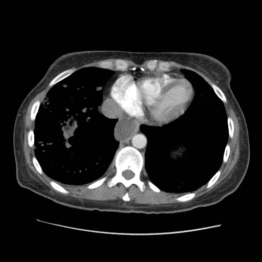 File:Aspiration pneumonia secondary to laparoscopic banding (Radiopaedia 18345-18183 A 41).jpg