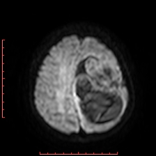 File:Astroblastoma (Radiopaedia 74287-85162 Axial DWI 82).jpg