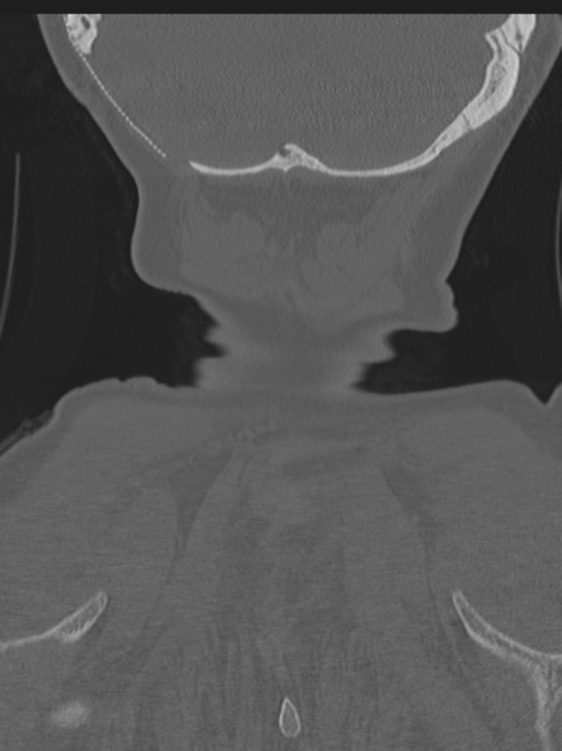 Atlanto-axial subluxation (Radiopaedia 36610-38176 Coronal bone window 51).png