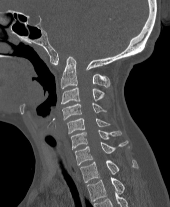 Atlanto-occipital assimilation with basilar invagination (Radiopaedia 70122-80188 Sagittal bone window 55).jpg