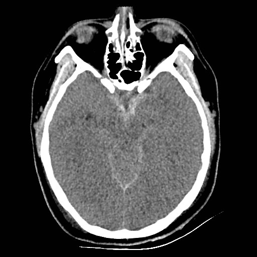 Atlanto-occipital dislocation (Radiopaedia 44648-48412 Axial non-contrast 22).jpg