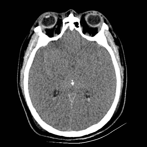 Atlanto-occipital dislocation (Radiopaedia 44648-48412 Axial non-contrast 27).jpg