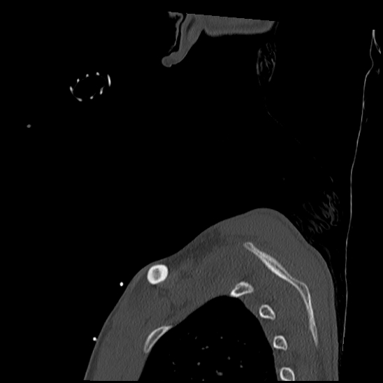 Atlanto-occipital dissociation (Traynelis type 1), C2 teardrop fracture, C6-7 facet joint dislocation (Radiopaedia 87655-104061 Sagittal bone window 74).jpg