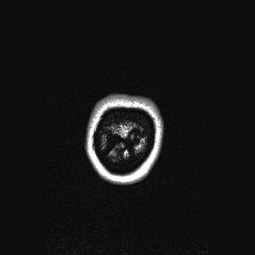 Atretic encephalocoele with inferior vermis hypoplasia (Radiopaedia 30443-31108 Coronal FLAIR 11).jpg