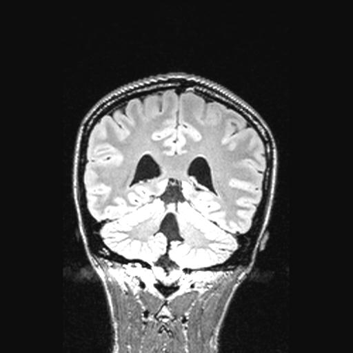 Atretic encephalocoele with inferior vermis hypoplasia (Radiopaedia 30443-31108 Coronal FLAIR 67).jpg