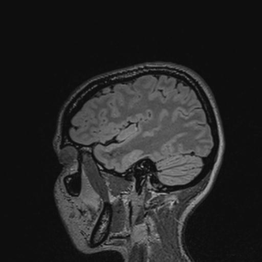 Atretic encephalocoele with inferior vermis hypoplasia (Radiopaedia 30443-31108 Sagittal FLAIR 120).jpg