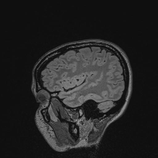 Atretic encephalocoele with inferior vermis hypoplasia (Radiopaedia 30443-31108 Sagittal FLAIR 42).jpg
