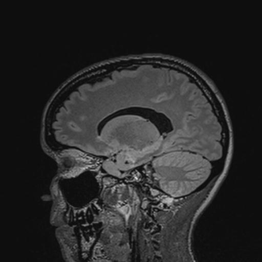 Atretic encephalocoele with inferior vermis hypoplasia (Radiopaedia 30443-31108 Sagittal FLAIR 65).jpg