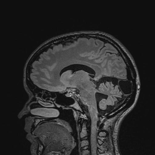 Atretic encephalocoele with inferior vermis hypoplasia (Radiopaedia 30443-31108 Sagittal FLAIR 88).jpg