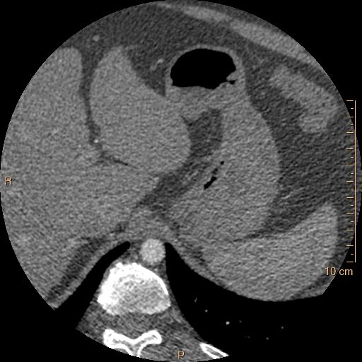 Atrial septal defect (upper sinus venosus type) with partial anomalous pulmonary venous return into superior vena cava (Radiopaedia 73228-83961 A 312).jpg