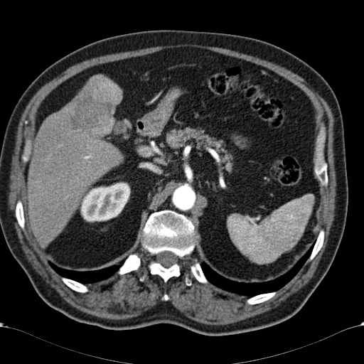 Atypical hepatocellular carcinoma (Radiopaedia 41744-44698 A 32).jpg