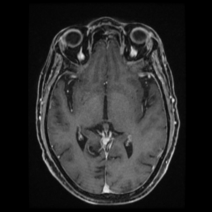Atypical meningioma (Radiopaedia 45535-49629 Axial T1 C+ 36).jpg
