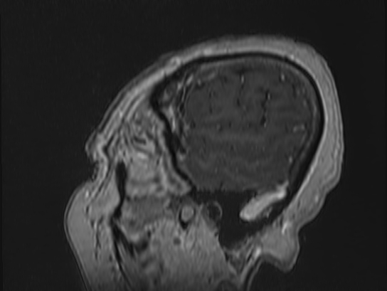 Atypical meningioma (Radiopaedia 62985-71406 Sagittal T1 C+ 5).jpg