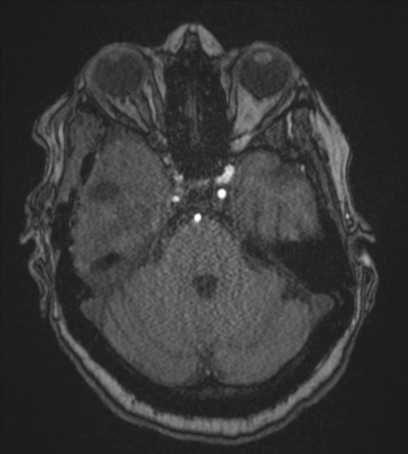 Atypical meningioma (WHO Grade II) (Radiopaedia 54742-60981 Axial MRA 29).png