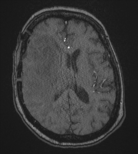 Atypical meningioma (WHO Grade II) (Radiopaedia 54742-60981 Axial MRA 58).png