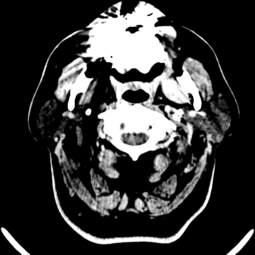 File:Atypical meningioma (WHO grade II) with brain invasion (Radiopaedia 57767-64728 Axial C+ 57).png