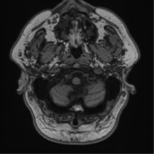 File:Atypical meningioma (WHO grade II) with brain invasion (Radiopaedia 57767-64729 Axial T1 3).png