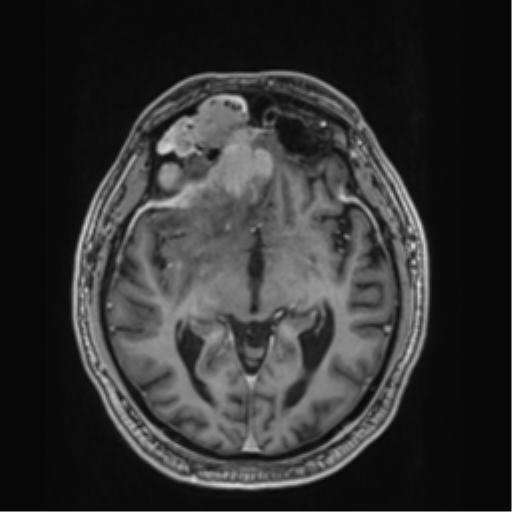 Atypical meningioma (WHO grade II) with brain invasion (Radiopaedia 57767-64729 Axial T1 C+ 21).png