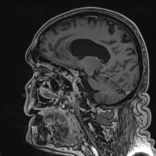 Atypical meningioma (WHO grade II) with brain invasion (Radiopaedia 57767-64729 Sagittal T1 C+ 31).png