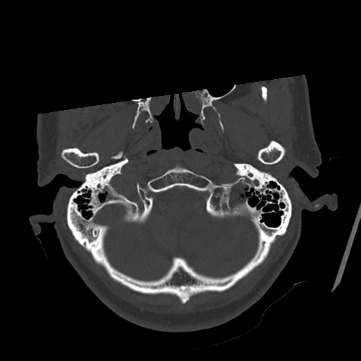 Atypical meningioma (WHO grade II) with osseous invasion (Radiopaedia 53654-59715 Axial bone window 13).png